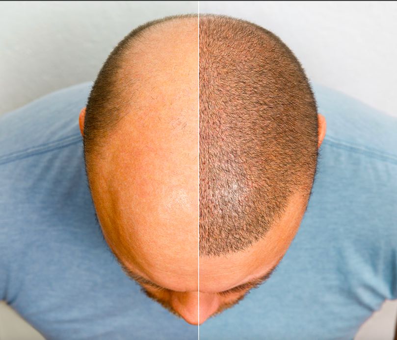 capelli trapianto prima e dopo - Life&People Magazine