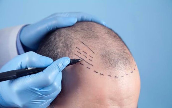cliniche trapianto capelli come sceglierla - Life&People Magazine